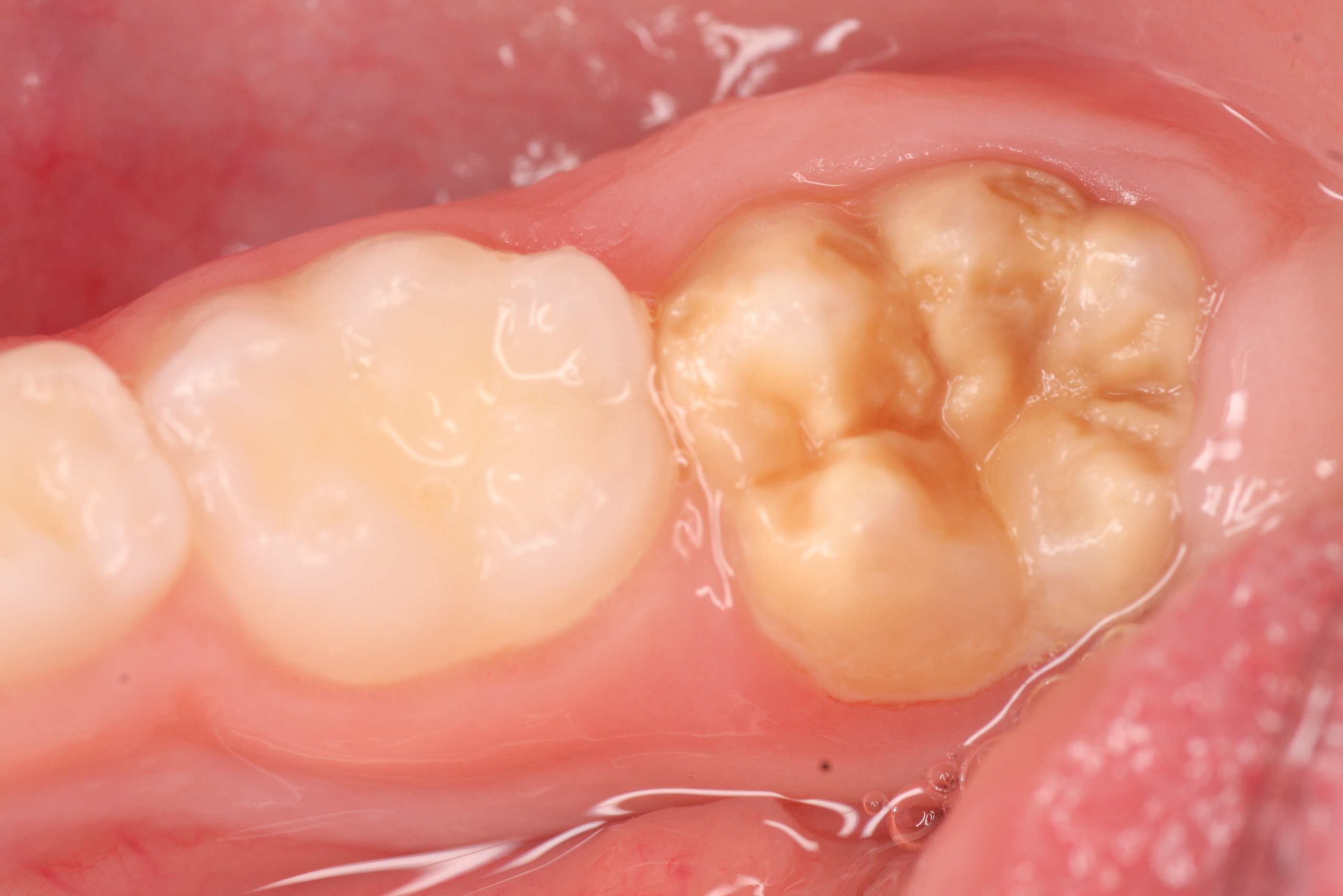 Diagnose MIH Was tun?